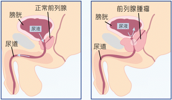 Lung Cancer pics