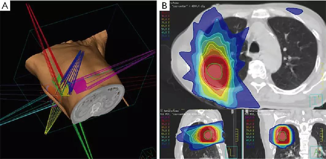 提升癌症患者5年平均生存率20%！立体定向放疗简介