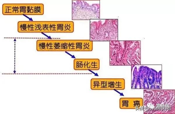 从中度异型增生，到胃早癌，只用了半年！