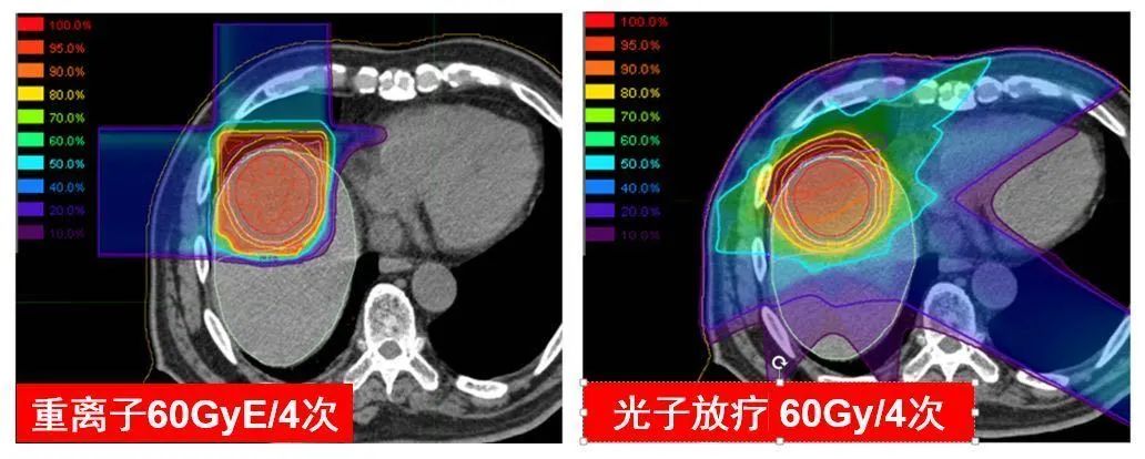 3年总生存率为72%,重离子治疗肝癌优势明显，上海市质子重离子医院疗效达国际同类机构先进水平