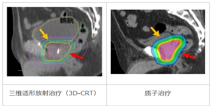 日本国立癌症中心东医院：前列腺癌的质子治疗经验