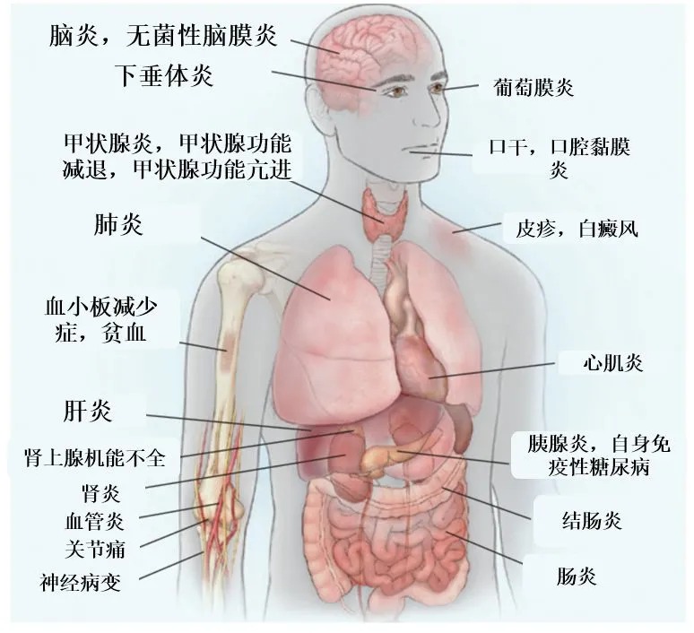 重要：了解免疫治疗相关的致死性不良反应