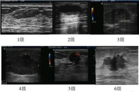 乳腺超声全介绍