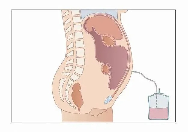 最全肿瘤腹水处理手册