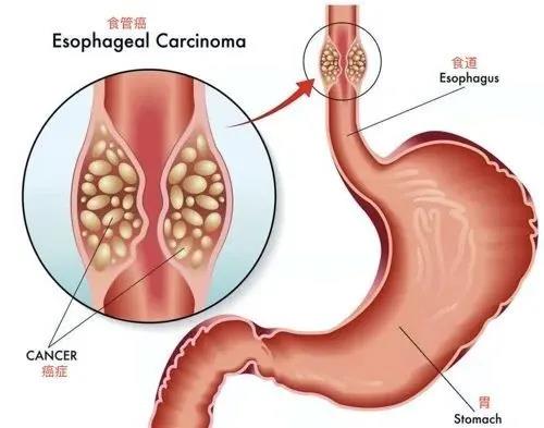 食管癌什么情况下选择放疗，一文带你了解食管癌放疗
