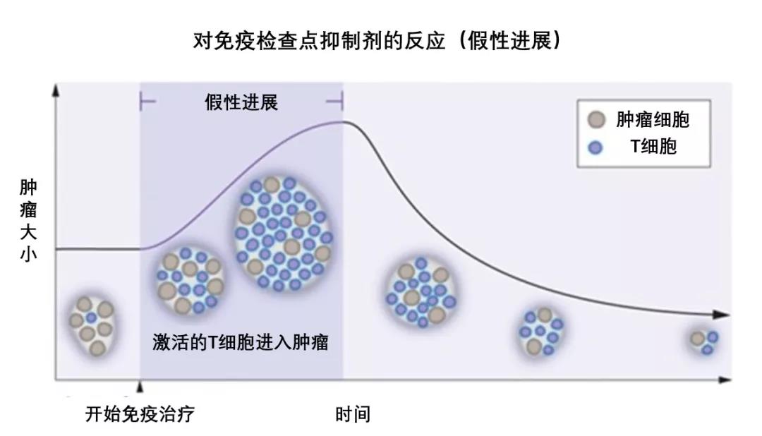 连肿瘤增大都可能是骗人的？免疫治疗中的“假性进展”介绍