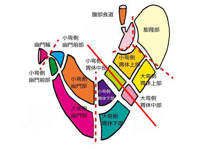 胃癌病人：医生！我整个胃都被切除了，未来还能正常吃饭吗？