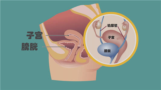 尿潴留发生率25% 宫颈癌常见术后并发症介绍