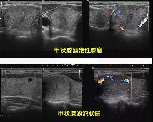 甲状腺滤泡状癌介绍