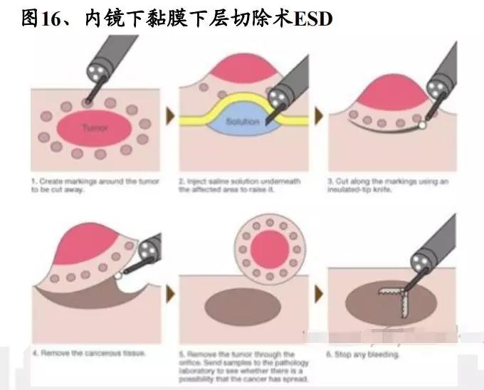 NCCN&CSCO胃癌指南，内镜下黏膜切除术EMR介绍