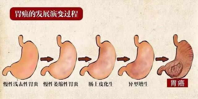 吃不下、打饱嗝，查出这种胃炎！有人变成癌，有人却逆转，关键在于……