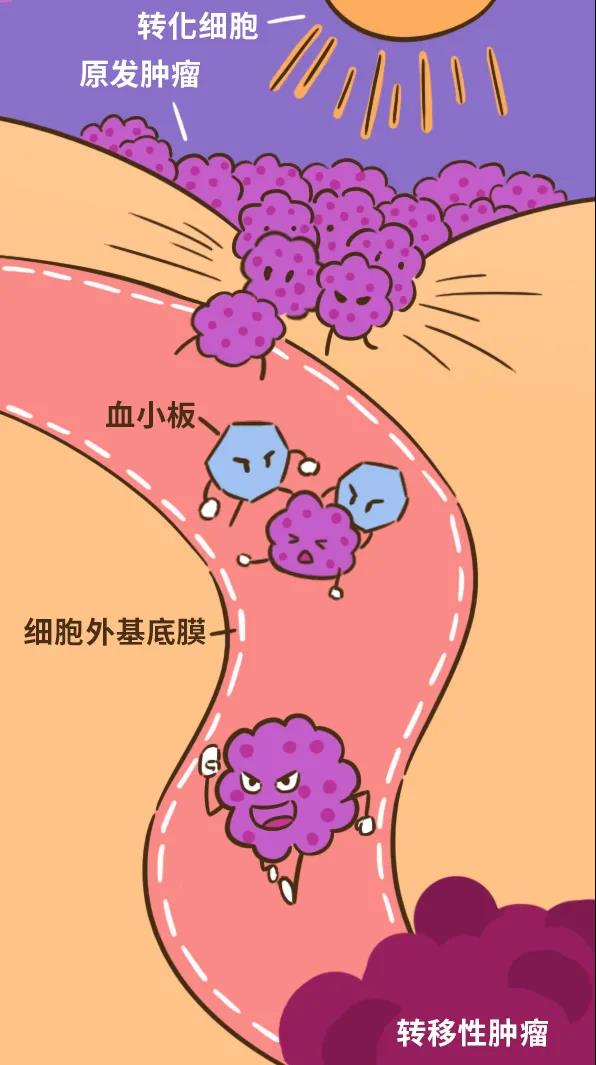 前列腺癌骨转移介绍