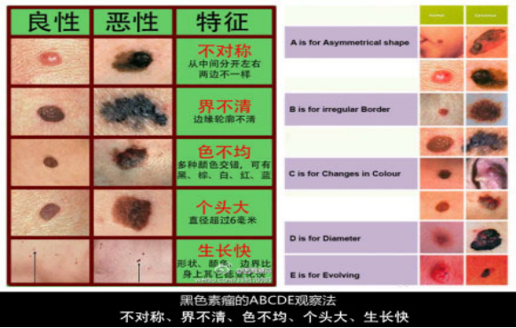 身边长痣的朋友，出现以下5种症状，需警惕是恶性黑色素瘤！