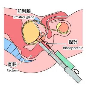 前列腺穿刺活检前后的有哪些注意事项