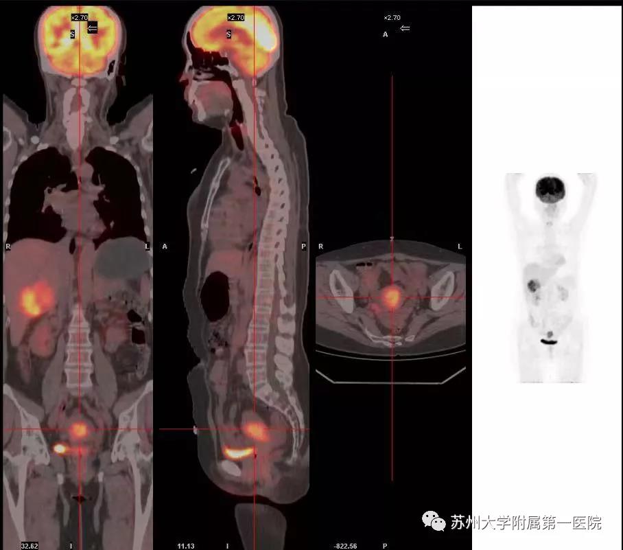 精准切“瘤”，为子宫内膜癌晚期患者博一线生机！