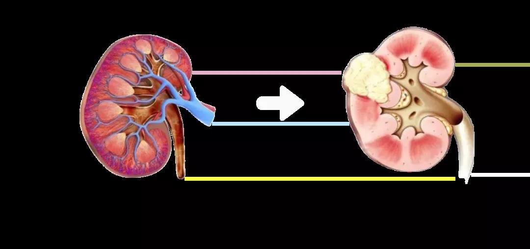 平时啥症状没有，一体检就是肾癌！警惕这些身体警告，看看平时你有没有？