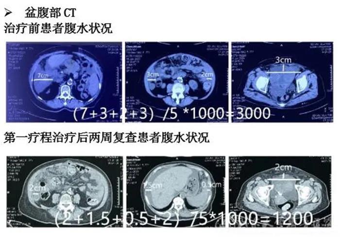 引入中国原研新技术，山东大学齐鲁医院妇产科完成载药囊泡治疗恶性腹水首例临床治疗