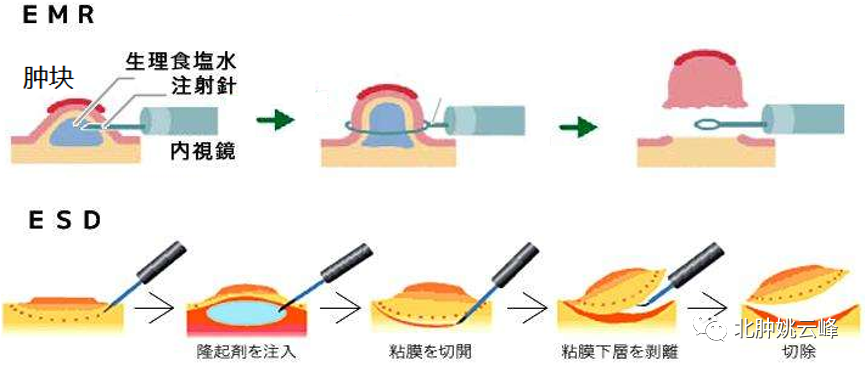 早期胃癌知识全了解