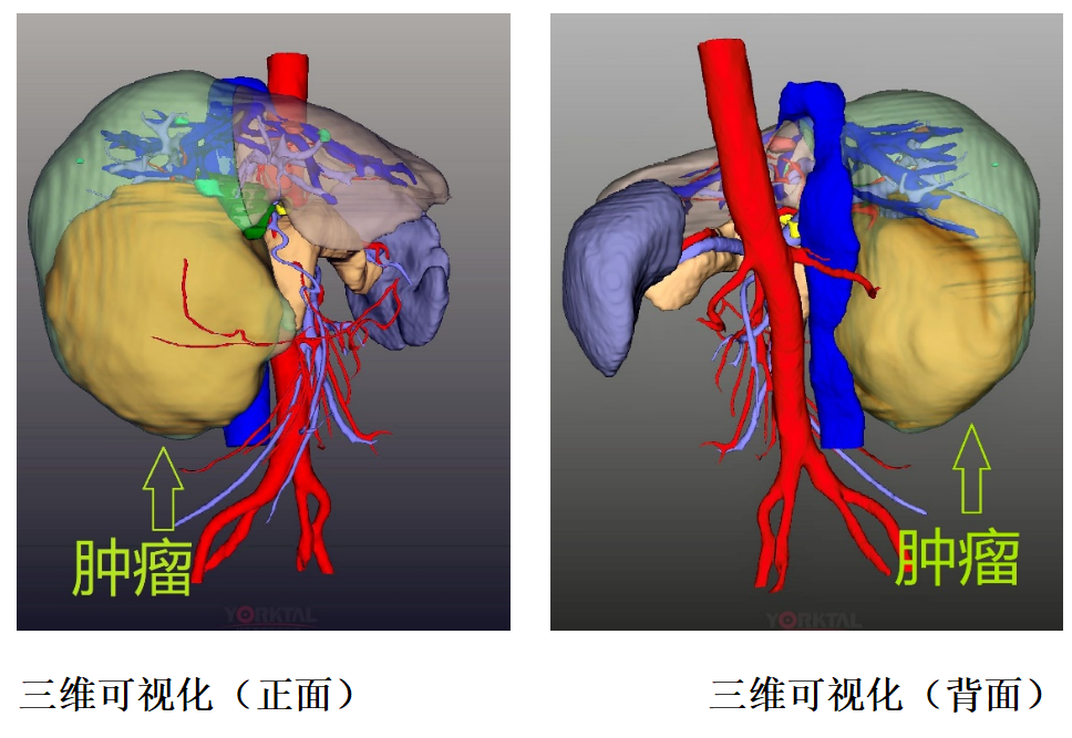 “达芬奇”牵手现代外科 | No Touch！不碰瘤体精细离断 哈医大一院