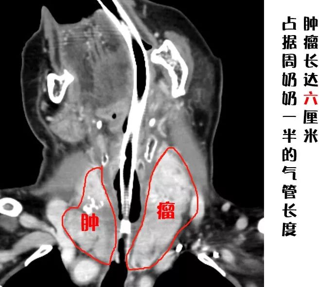 呼吸困难误当哮喘治，一查竟是甲状腺肿瘤侵犯气管了，东南大学附属中