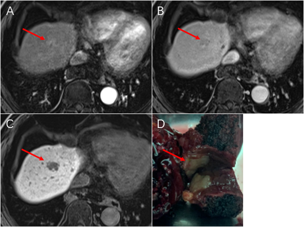 微小肝癌的“侦察兵”，肝细胞特异性对比剂磁共振增强检查可以助力