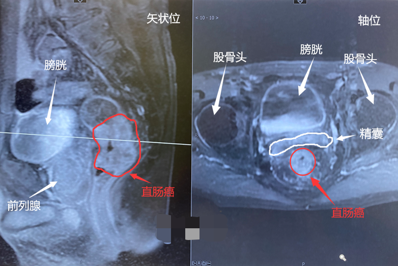 新辅助治疗扭转直肠癌患者的命运！