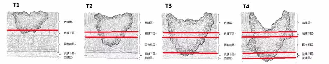 教您读懂肠癌患者病理报告中的各种信息