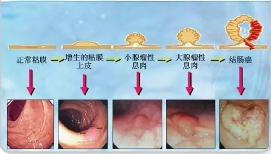 前年肠镜没事，今年就查出结肠癌！肠镜究竟多久做一次保险？