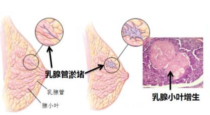 科普篇 | 乳腺癌的组织学分级与预后