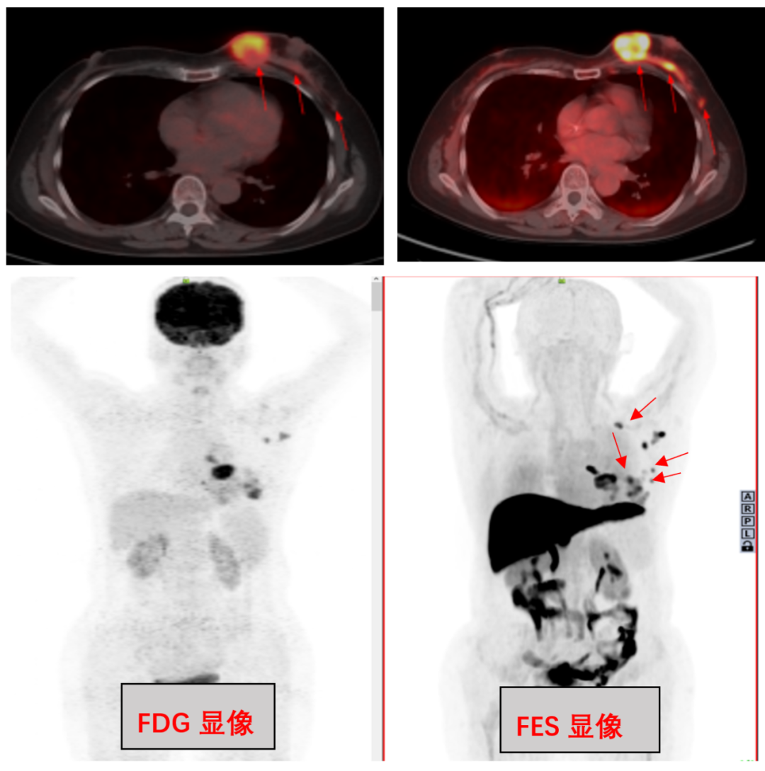 特色诊疗｜吉林省肿瘤医院核医学科成功开展全省首例??F-FES ER阳性