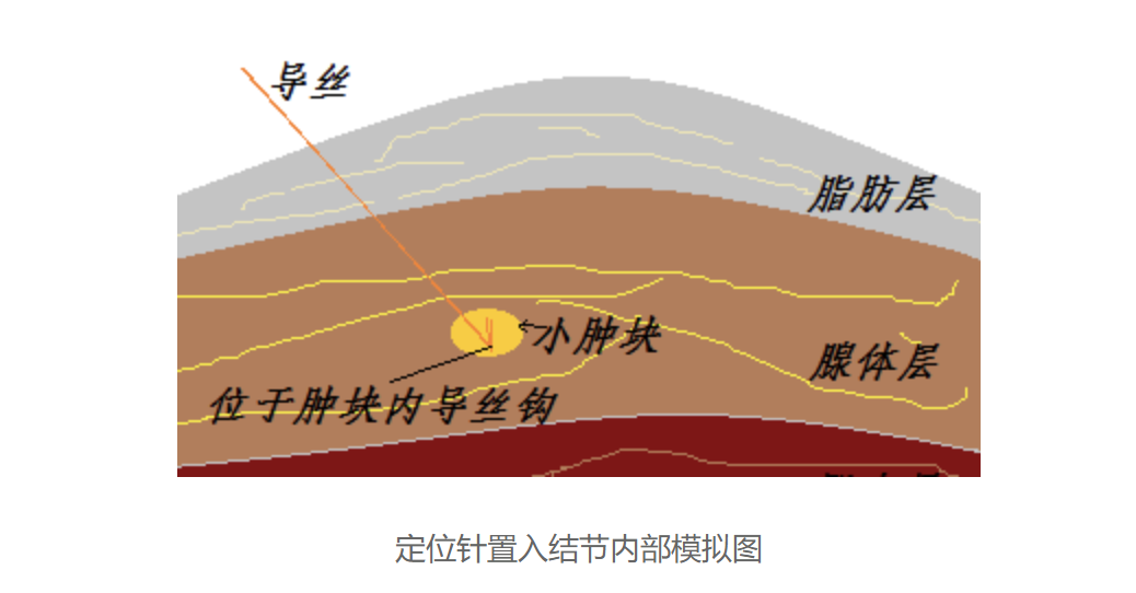 超声引导下钩针定位，让乳腺小结节无处可逃