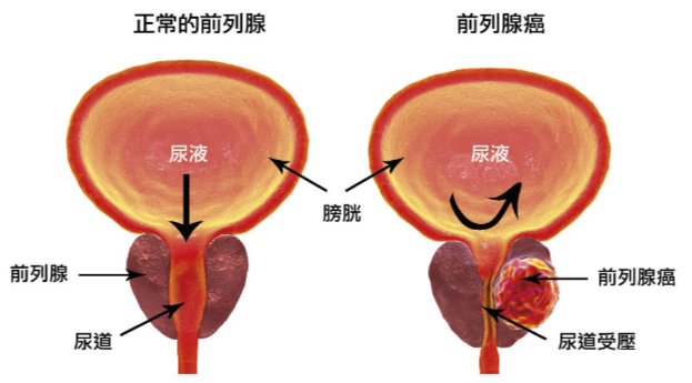 尿频、夜尿多？警惕老年男性的难言之隐