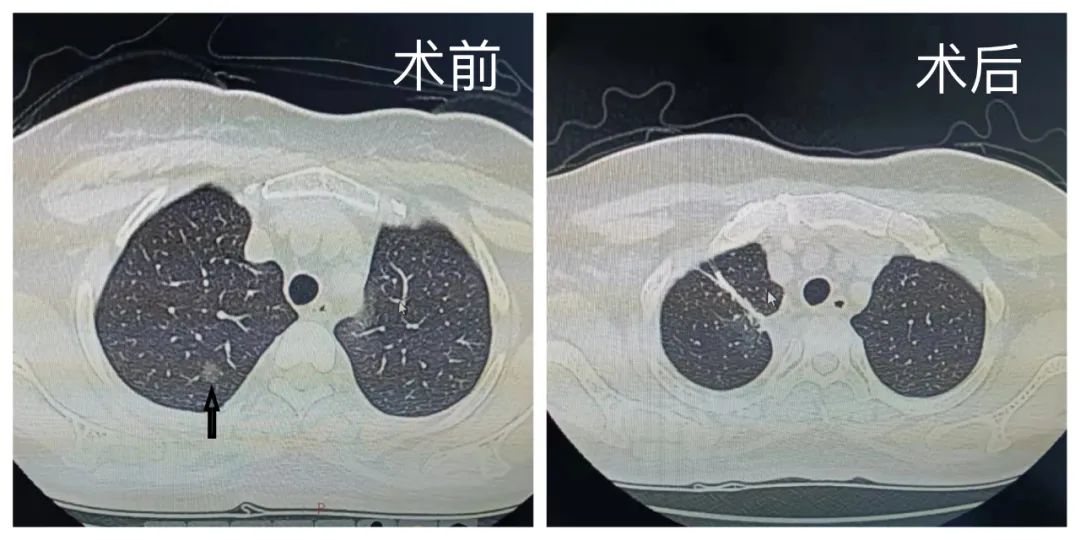 【我为群众办实事】北京胸科医院以肺亚段为中心精准肺切除治疗早