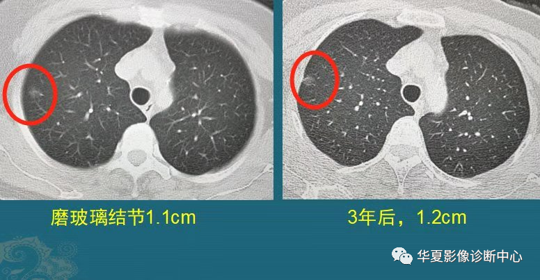 磨玻璃肺结节随访观察，会不会变成肺癌？带你看随访4种结局