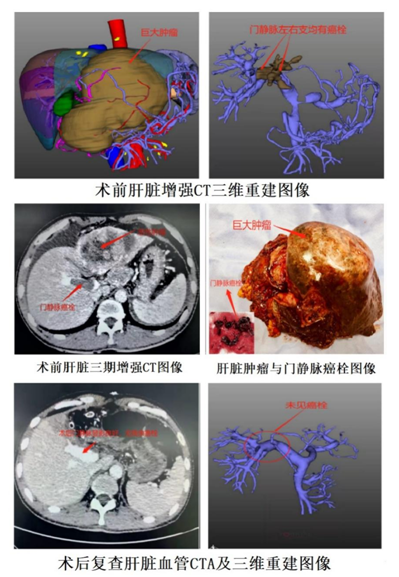 哈医大一院肝脏微创外科成功完成高难度肝癌切除手术