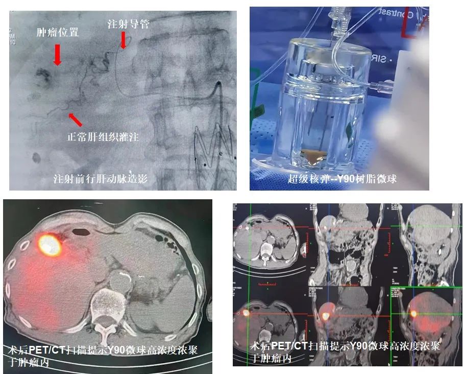 重庆首例！西南首例！医院成功实施钇90微球精准肝癌介入手术
