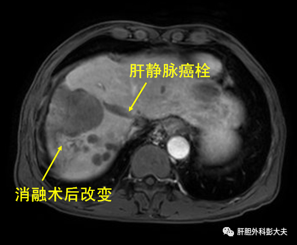 冷冻消融显神威 北京世纪坛医院完成首例晚期巨大肝癌冷冻消融治