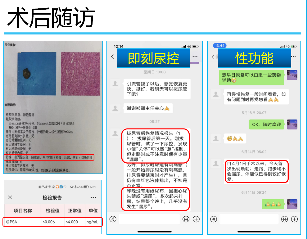 【协和医疗】泌尿外科运用达芬奇辅助腹腔镜前列腺癌根治术达成“