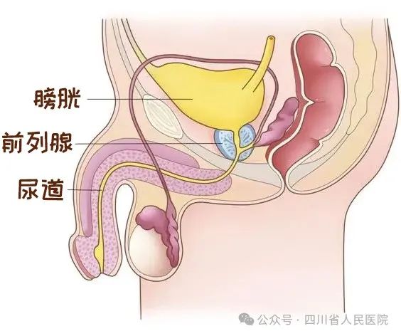 尿急、尿频、尿不尽，前列腺到底是增生还是癌起了？