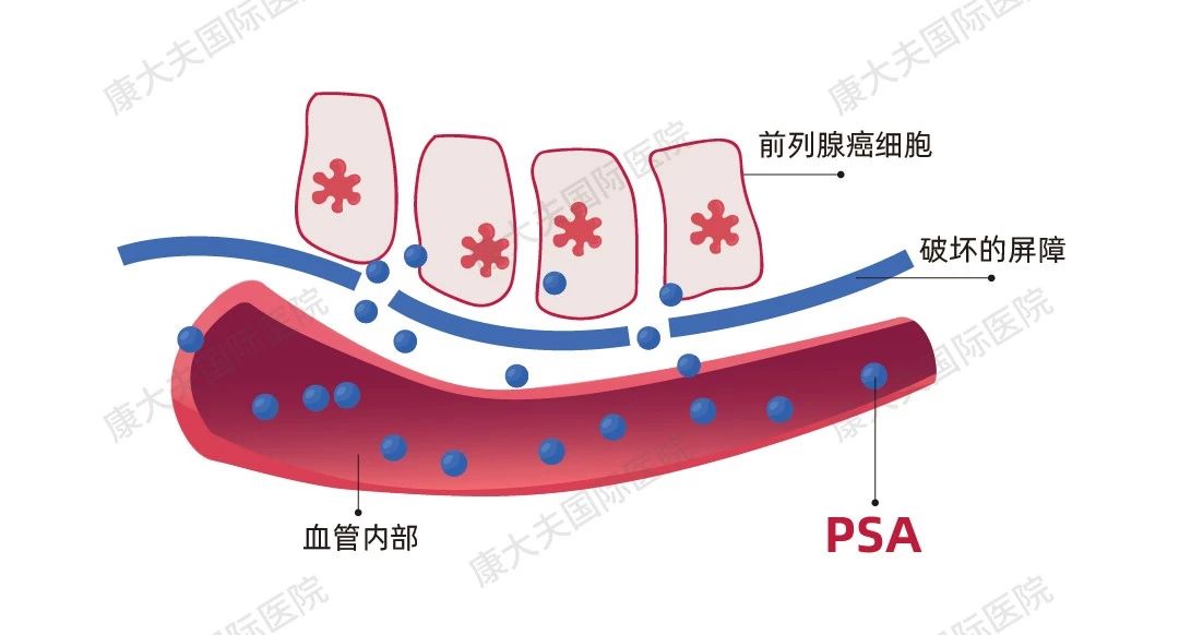 同是PSA升高为什么一个是癌，一个是炎症？