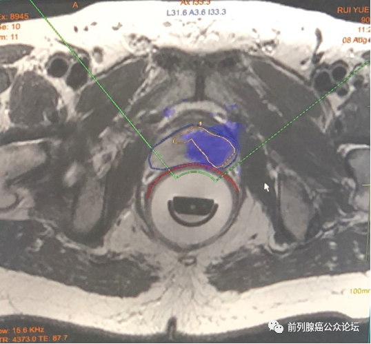北京医院首例前列腺癌磁共振引导聚焦超声治疗