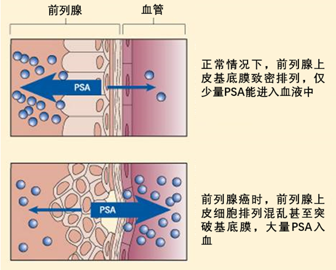 前列腺特异抗原（PSA）到底是个啥