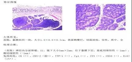 直肠神经内分泌肿瘤的诊与治