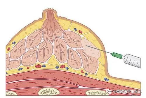 乳腺包块穿刺介绍