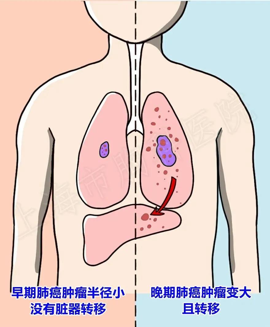 放疗在早期肺癌中的运用