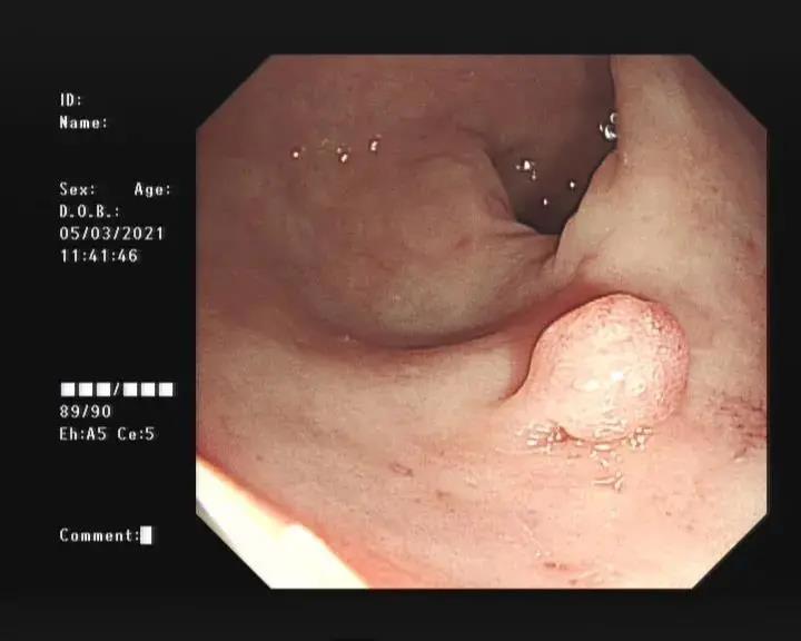 结直肠息肉如何管理？日本最新指南来了