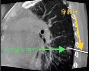 为什么需要做穿刺活检？ 穿刺活检完需要注意些什么？