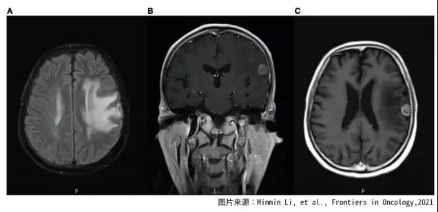 晚期脑转移肺癌患者如何拥有12年有质量的生存期?