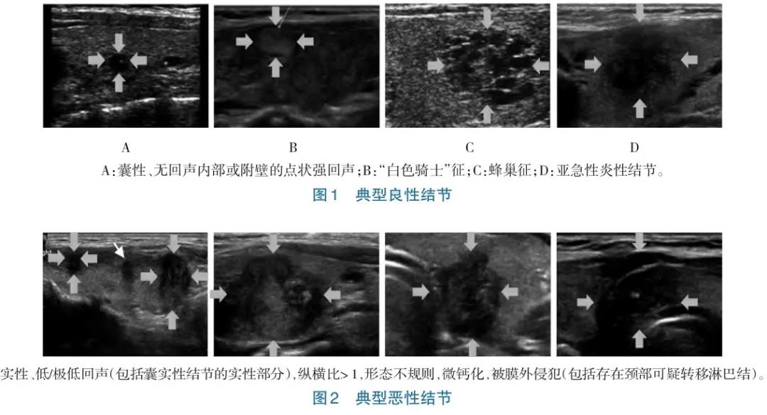 为什么有的甲状腺结节需要穿刺？