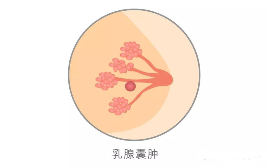 查出囊肿心慌慌？别怕，从这几点正确认识乳腺囊肿